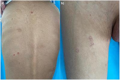 Case Report: Pediatric Malignant Atrophic Papulosis With Small Bowel Perforation and Positivity of Anticardiolipin Antibody